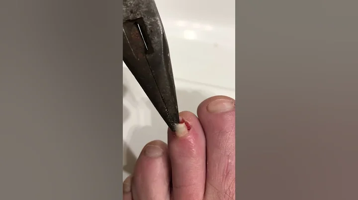Must watch.! Home toenail removal.