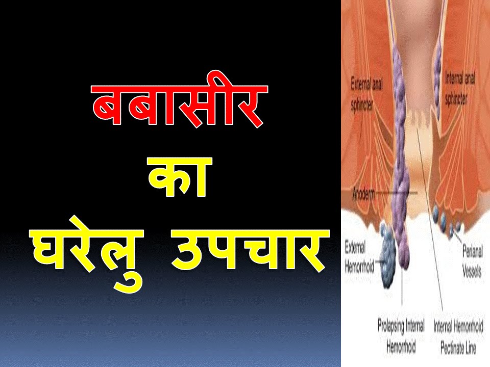 how to remove piles at home without any problem बबासीर का घरेलु उपचार हिंदी में YouTube