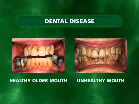 ಓರಲ್ ಹೆಲ್ತ್ ಬೇಸಿಕ್ಸ್ - ಡೆಂಟಲ್ ಡಿಸೀಸ್