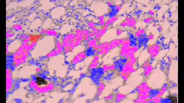 Ki67 labeling index in breast carcinoma slice