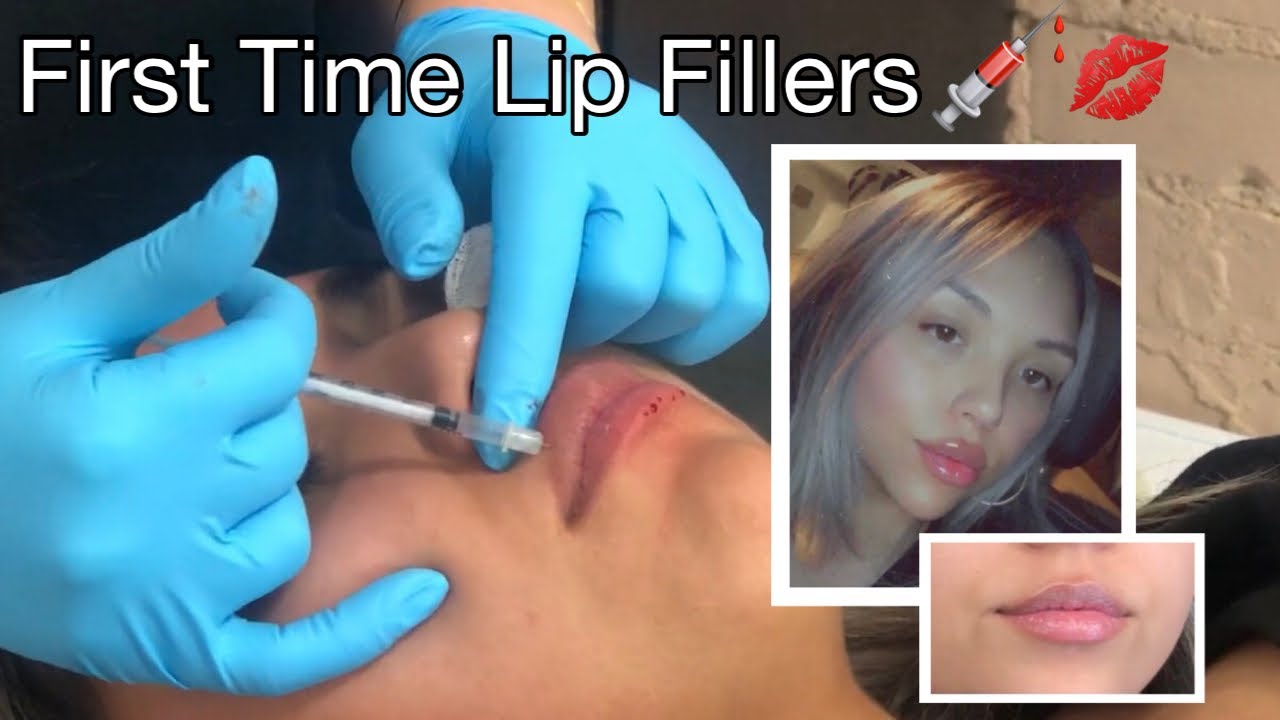 Lip Filller Vlog!!