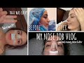 Rhinoplasty Vlog | My Nose Job Experience *EASY!*