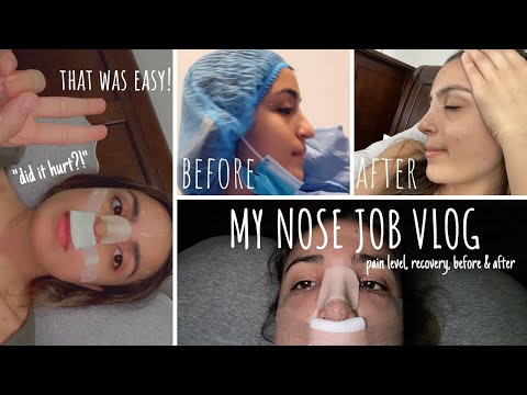 Video: Matokeo ya rhinoplasty ya Lina