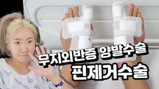 ◀무지외반증수술후기▶소건막류수술ㅣ 핀제거수술ㅣ핀부러짐!!ㅣ양발수술 ㅣ4개월차