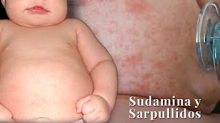 🔴 RASH ON YOUR BABY (MILIARIA OR PEPPER RASH) EVERYTHING YOU NEED TO KNOW