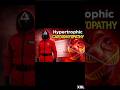 Hypertrophic Cardiomyopathy