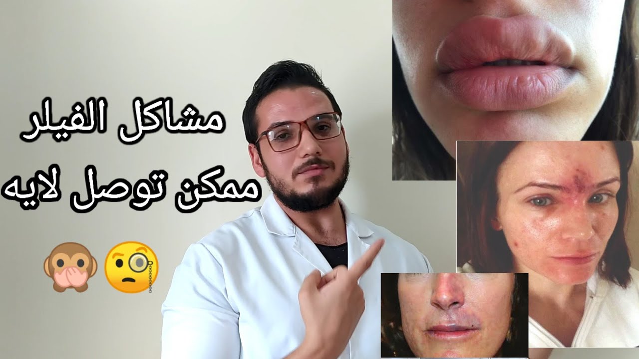 اضرار الفيلر ممكن توصل لايه ؟؟ تجنبها قبل حدوثها مع العلاج