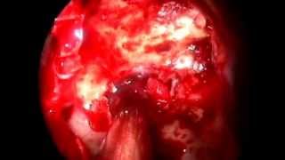 Paraganglioma Sellar- Suprasellar