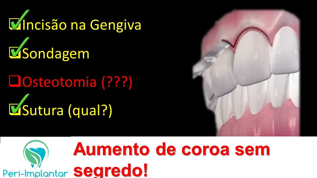 O que você precisa saber sobre aumento de coroa clínica antes de iniciar?