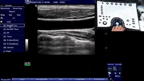 NextGen LOGIQ e: IMT (Carotid)
