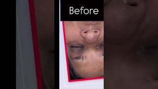 #aeternum #aeternumcupping #beforeafter