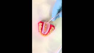 Ronaldo Hirata TIPS 45 Odontologia Estética (Esthetic Dentistry): tip of posterior provisional