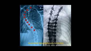 Successful Scoliosis Surgery in Teen | Neuromonitoring Spine Correction by Dr. Manoj Kumar