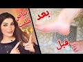 قولي وداعا لتشققات وخشونة القدمين واسمرارها ترطيب تنعيم وتوريد فوري نتيجة فعالة وفورية