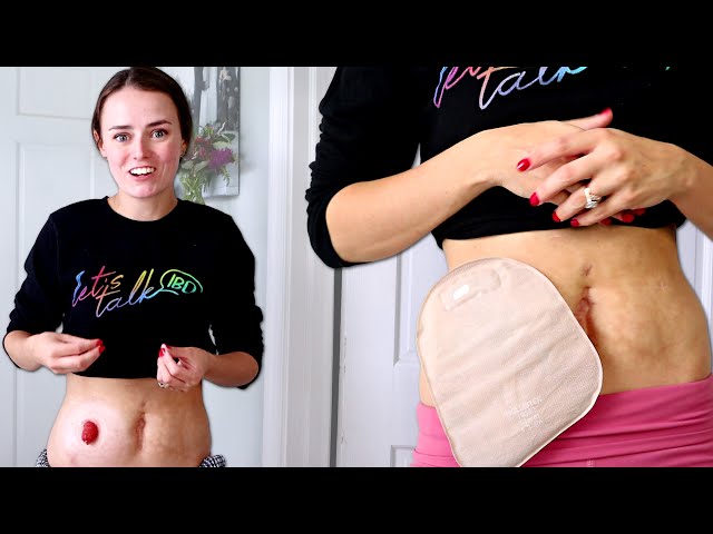 Removing an Ostomy Appliance & Cleaning the Skin, Nurse with a Stoma