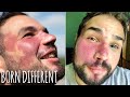 Bullied For My Birthmark - But Now I Embrace It | BORN DIFFERENT