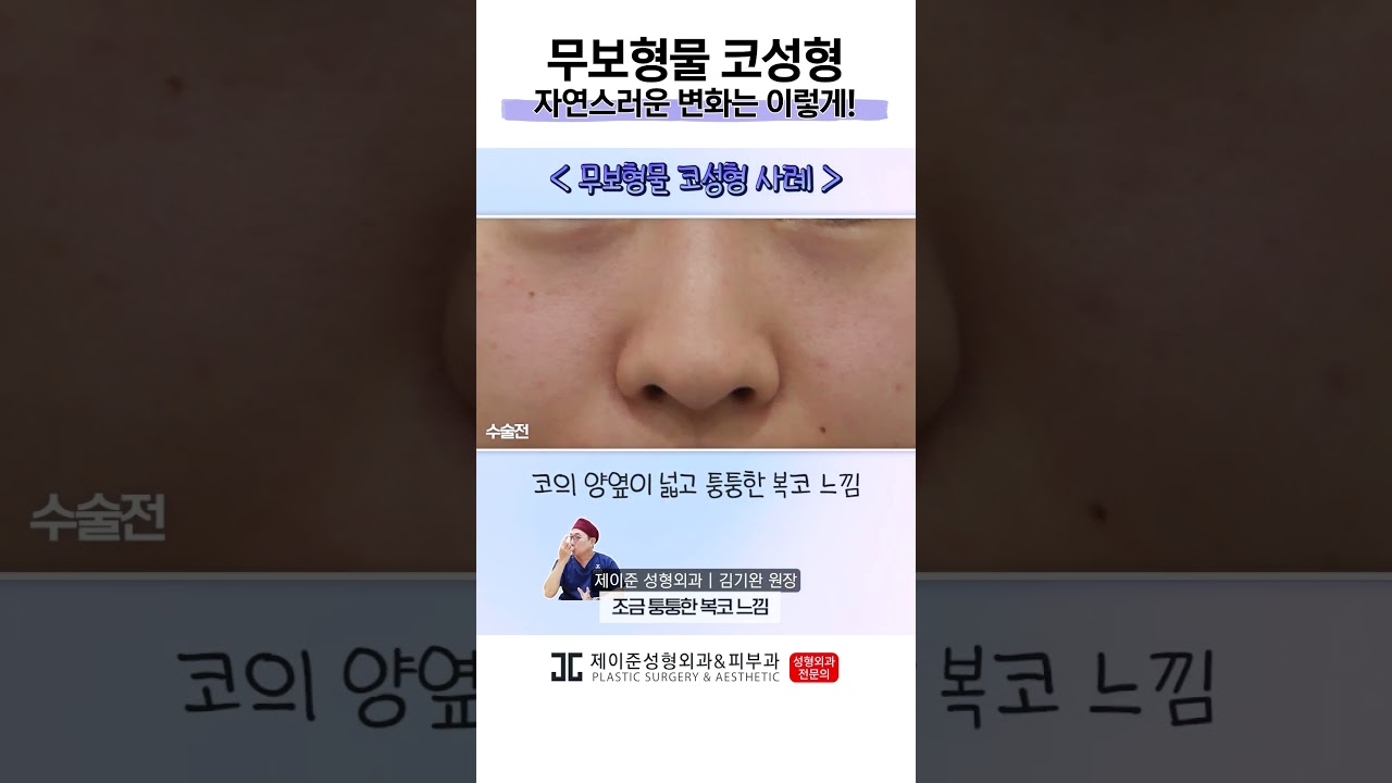 [Thẩm mỹ viện Jayjun, Da liễu] Nâng mũi trước và sau, biến đổi tự nhiên ✨ #shorts #김기완 #제이준성형외과