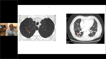 6. The implementation of AI in Radiology - Fergus Gleeson (NCIMI)