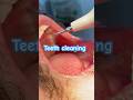 Teeth cleaning 🦷 #drvarshha #foreigntraineddentist #doctor