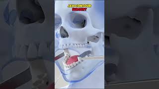 Jaw Contour Surgery 3D Animation #jaw #contour #surgery #cosmetics #3danimation