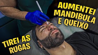 HARMONIZEI O ROSTO INTEIRO! 😱 AUMENTEI MANDÍBULA E QUEIXO, TIREI AS RUGAS E OLHEIRAS...