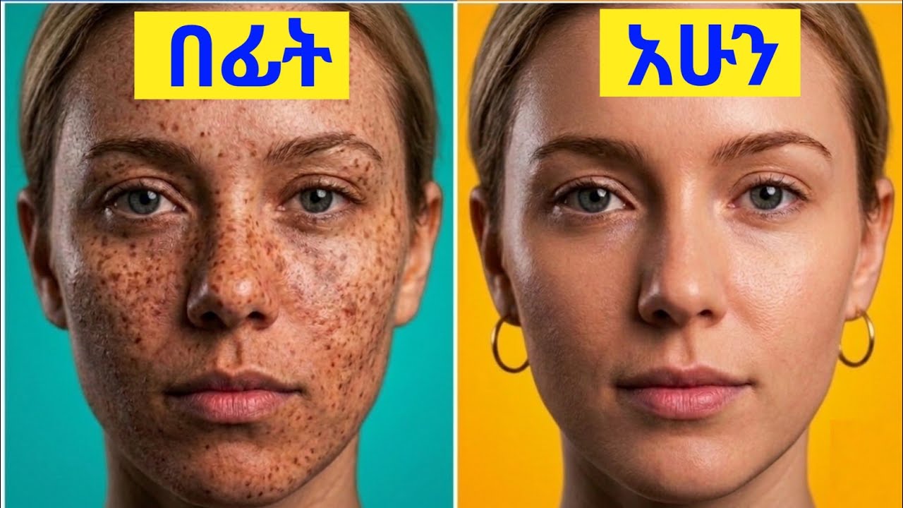 ፊት ላይ የሚወጡ ጥቁር ነጠብጣቦችን ለማጥፋት 9ቱ ፍቱን የተፈጥሮ መፍትሄዎች