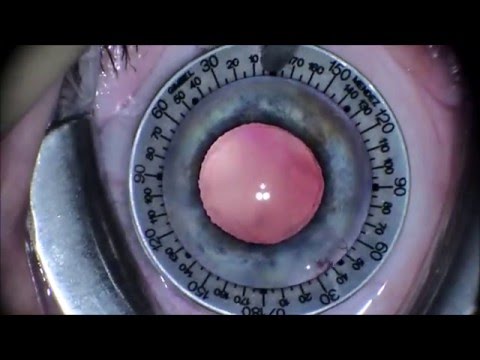 alcon launches new trifocal