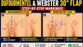 Dufourmentel Flap vs Webster 30° Flap | Step-by-Step Markings & Surgical Design Explained