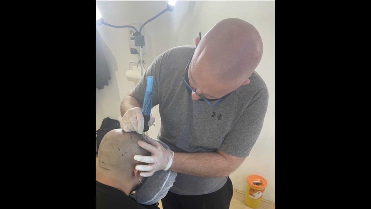Who is Scalp Micropigmentation For?