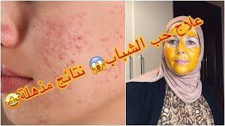 علاج حب الشباب? نتائج مذهلة?