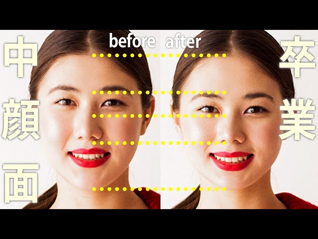 Severe pain Face length plastic surgery Change face shape - YouTube