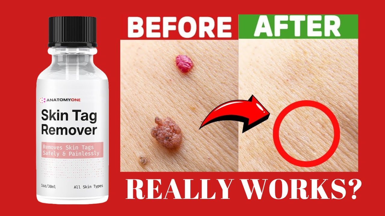(Anatomy One) AnatomyOne Skin Tag Remover Reviews - Watch Before Buying - Anatomyone Skin Tag Remover Where To Buy