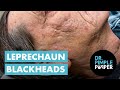 Leprechaun Blackheads