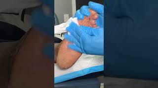 Thick Calluses And Athletes Feet