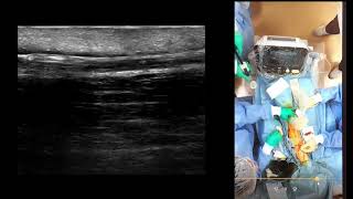 Do VAIVT(PTA) in your Kidney OPD room (Short Ver.)