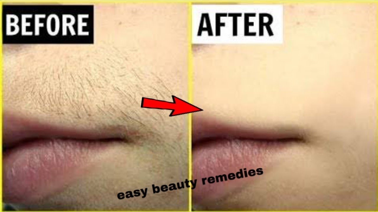 होंठो के ऊपर के बाल upper lips hair एक बार हटाने पर दोबारा नही आपाएंगे