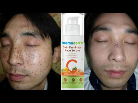 mamaearth cream for freckles