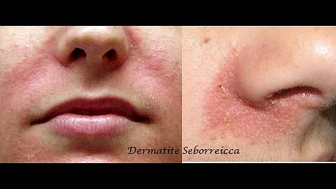 Como tratar dermatite seborreica no nariz?