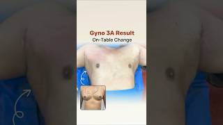 From Enlarged Chest to Flat Contour | Grade 3A Gynecomastia (Male Breast Reduction) On-Table Result
