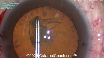 CataractCoach™ 2633: De kleine capsulorhexis-reddingstechniek