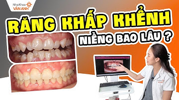 Niềng Răng Khấp Khểnh Mất Bao Lâu? Chỉ Điểm 3 Ca Khác Nhau Với Kết Quả Gây “Shock”