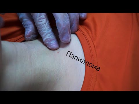 Как Удалить Бородавку За 30 Секунд