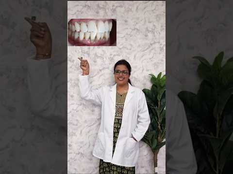 Teeth scaling: a refreshed smile