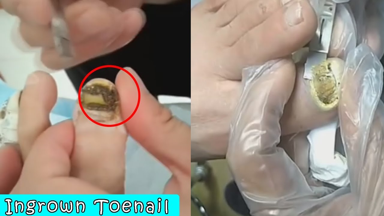 Ingrown Toenail Surgery | How to Removal | Treatment Pedicure Tutorial #13 - YouTube