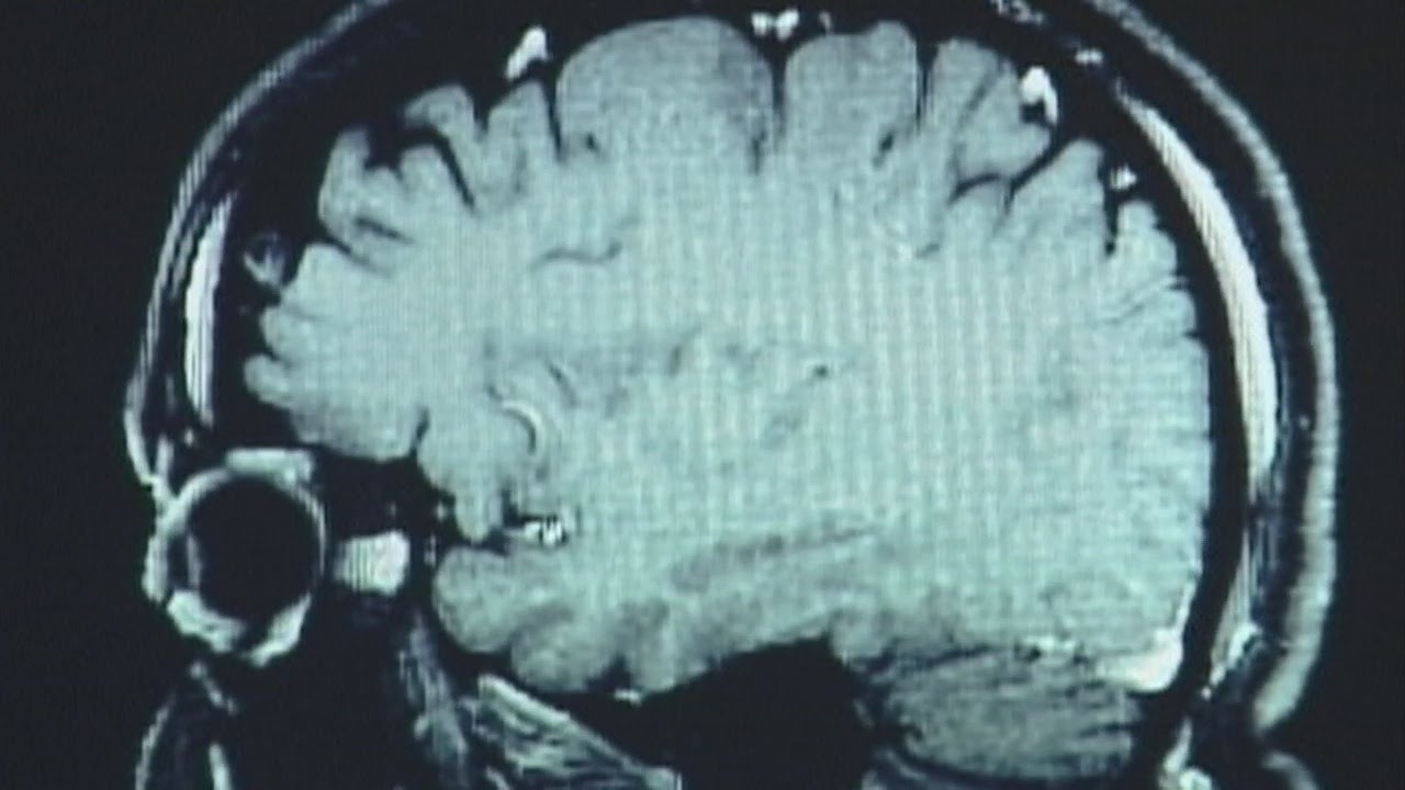 New Eye Technology Can Help Diagnose Brain Injuries Faster