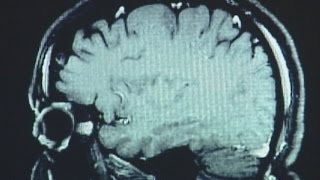 New Eye Technology Can Help Diagnose Brain Injuries Faster