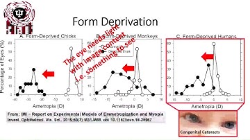 Emmetropization   Visually guided growth Source