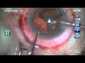 Stephen Slade MD LIVE Laser Cataract Surgery