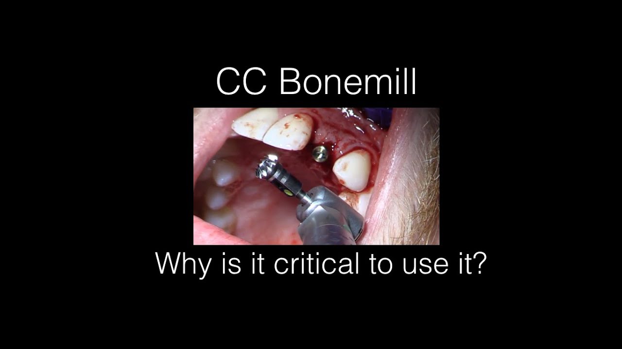 Bone Mill For The Conical Connection Implant From Nobelbiocare YouTube bone-mill-for-the-conical-connection-implant-from-nobelbiocare-youtube