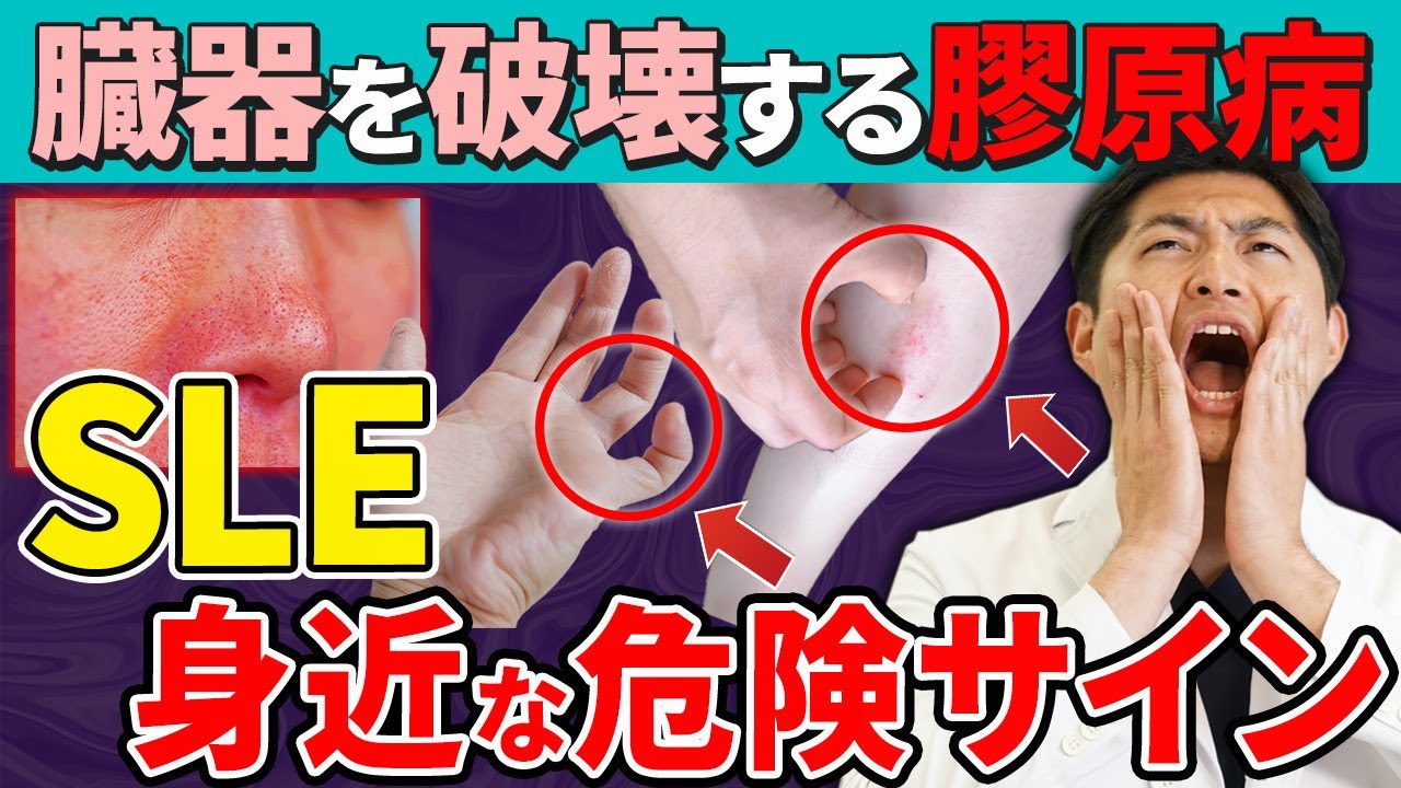 【要注意】気がついたら全身が炎症！？知らないと後悔する危険サインを現役医師が解説！【膠原病/SLE】